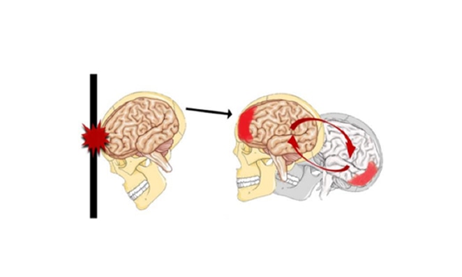 Movimentação da cabeça causando uma concussão